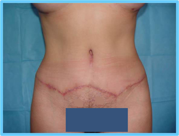 tummy tuck